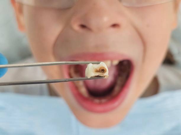 Best Dentist for Tooth Abscess  in St Charles, MO